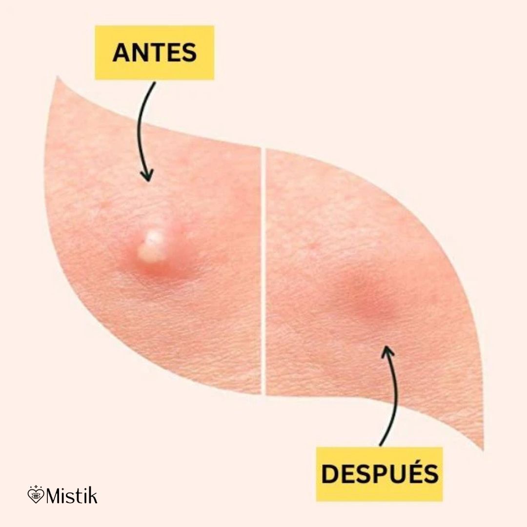 Parches Misión Rescate de Ácido Salicílico